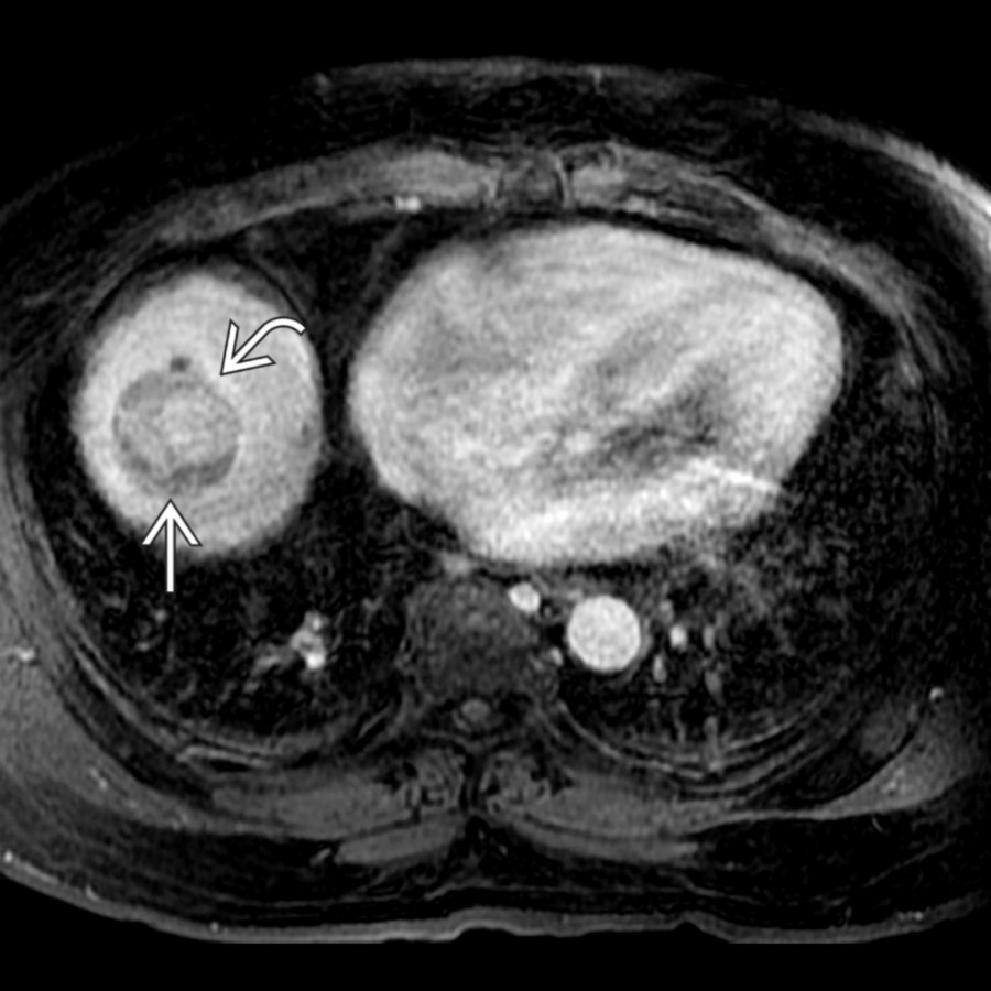 S03-FIG-05A|T1 C+ FS MR/axial:圖 1/2。延遲期增強 T1 MRI:腫塊已 washout(白實箭頭),周邊可見 capsule(白彎箭頭),為 HCC 主要徵象。