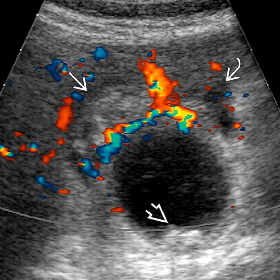 S03-FIG-08|color Doppler ultrasound/transverse:橫切彩色 Doppler:壞疽性膽囊炎可見膽囊底周圍網膜脂肪 hyperemia、少量膽囊周圍液體與小結石。
