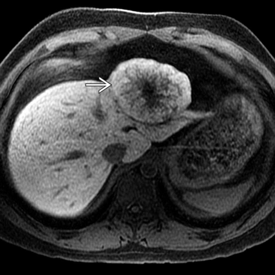 S03-FIG-03A|Eovist-enhanced T1 MR, delayed phase/axial:圖 1/2。Eovist 注射後 20 分鐘 HBP:FNH 內對肝細胞特異性對比劑呈近均勻保留;中央瘢痕因無 hepatocytes 而不增強。