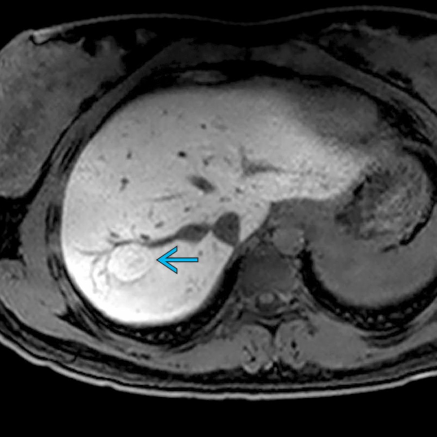 S03-FIG-03B|Eovist-enhanced T1 MR, delayed phase/axial:圖 2/2。Eovist 20 分鐘 HBP:病灶相較背景肝仍呈輕度均勻高訊號(青箭頭),支持 FNH 的 OATP/hepatocyte uptake。