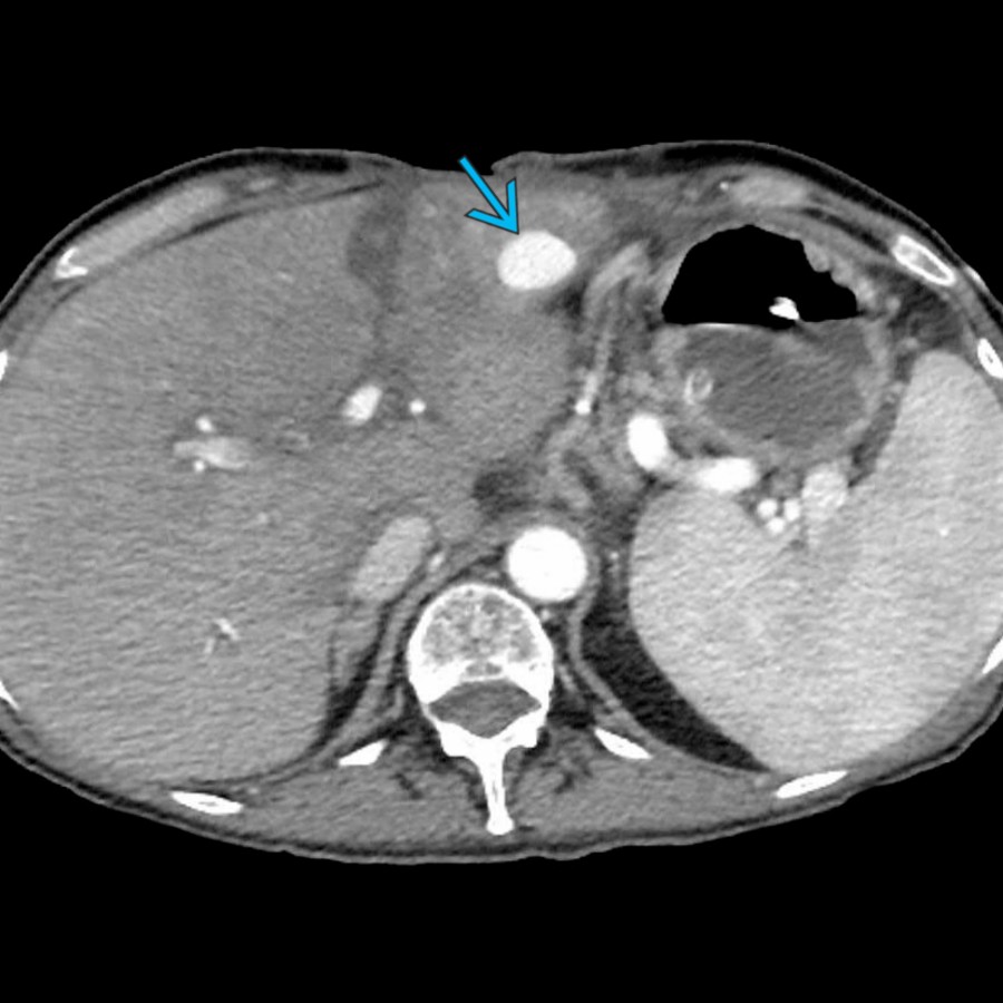 S03-FIG-09A|CECT, arterial phase/axial:圖 1/2。動脈期 CECT:青箭頭標示左肝葉內 hepatic artery pseudoaneurysm,密度與同時期動脈血池一致。