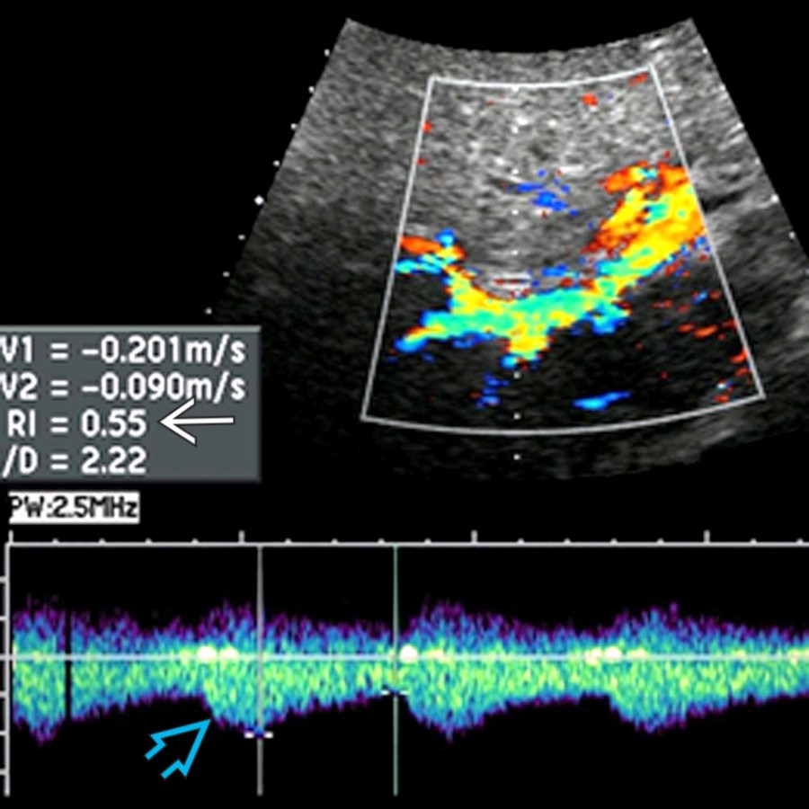 S03-FIG-10|doppler ultrasound/spectral Doppler:右 hepatic artery spectral Doppler:收縮期上升遲鈍的 tardus-parvus 波形(青空心箭頭)合併低 RI(白實箭頭),提示上游狹窄。