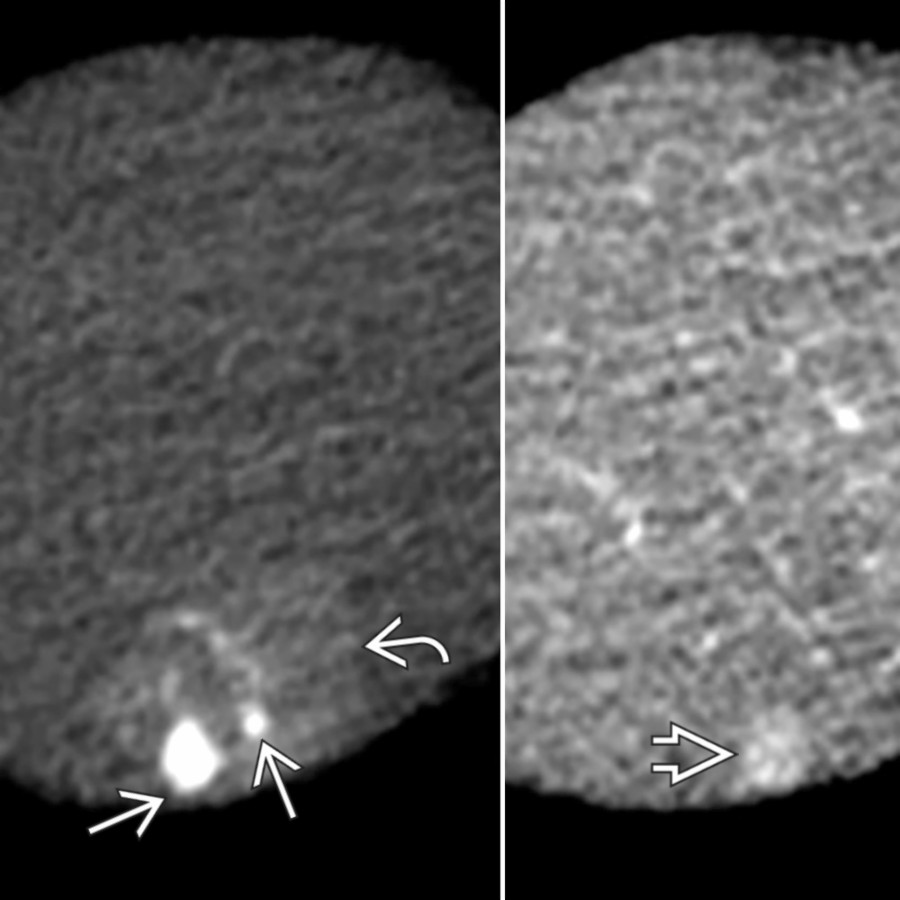 S03-FIG-02|CECT, arterial phase/axial:動脈期 CECT:白實箭頭為肝頂部 flash-filling hemangiomas,白彎箭頭標示鄰近 THAD;後者是灌流改變,不應另算一顆腫塊。