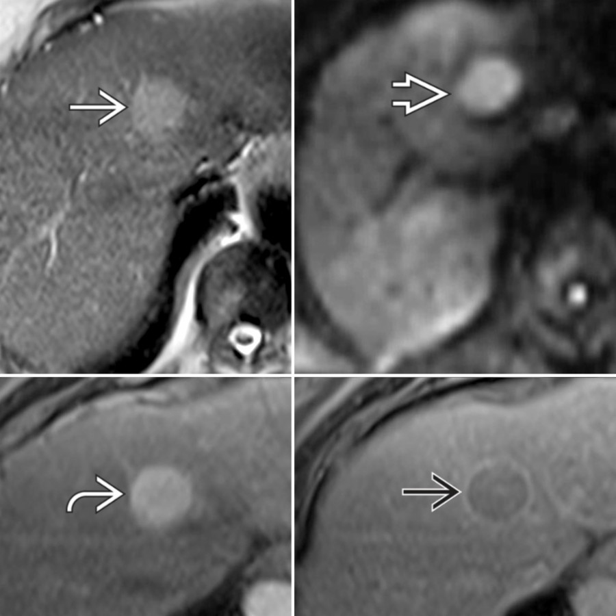 S03-FIG-05B|MR/axial:圖 2/2。同一 HCC 的多序列 MRI:T2 高訊號、diffusion restriction、arterial hyperenhancement、靜脈期 washout 與 capsule 同時成立。