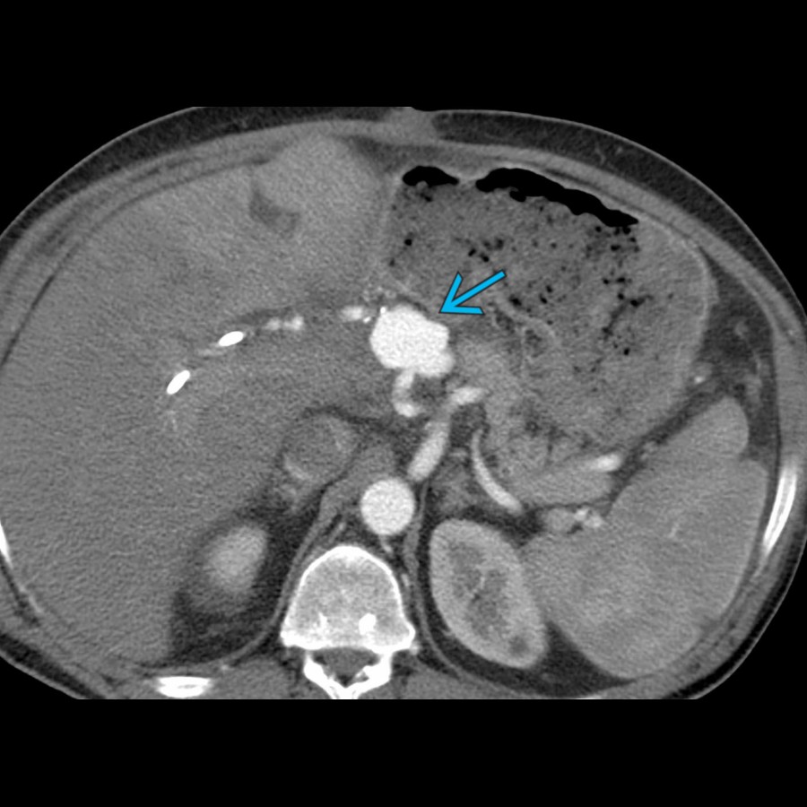 S03-FIG-09B|CECT, arterial phase/axial:圖 2/2。動脈期 CECT:主 hepatic artery 在動脈吻合處呈局部瘤樣擴張(青箭頭),符合 anastomotic pseudoaneurysm。