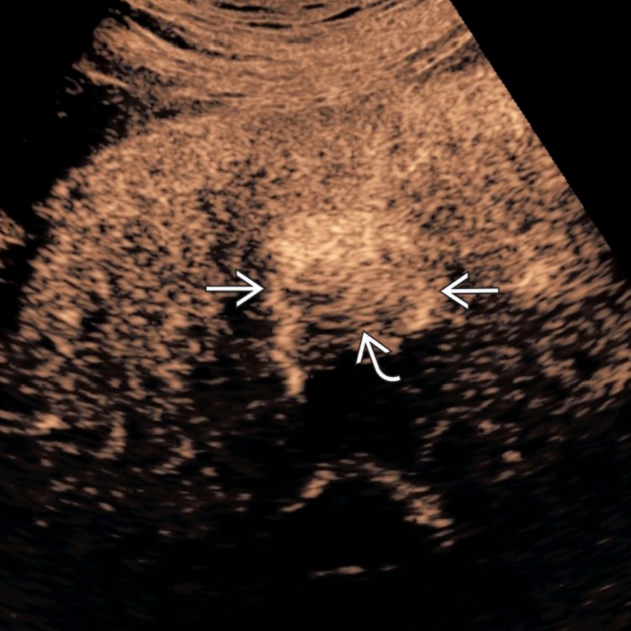 S03-FIG-06A|contrast-enhanced ultrasound (CEUS)/transverse:圖 1/2。動脈期 CEUS:mass-forming iCCA 呈 rim APHE(白實箭頭)與中央低增強(白彎箭頭),走 LR-M/targetoid 路徑。
