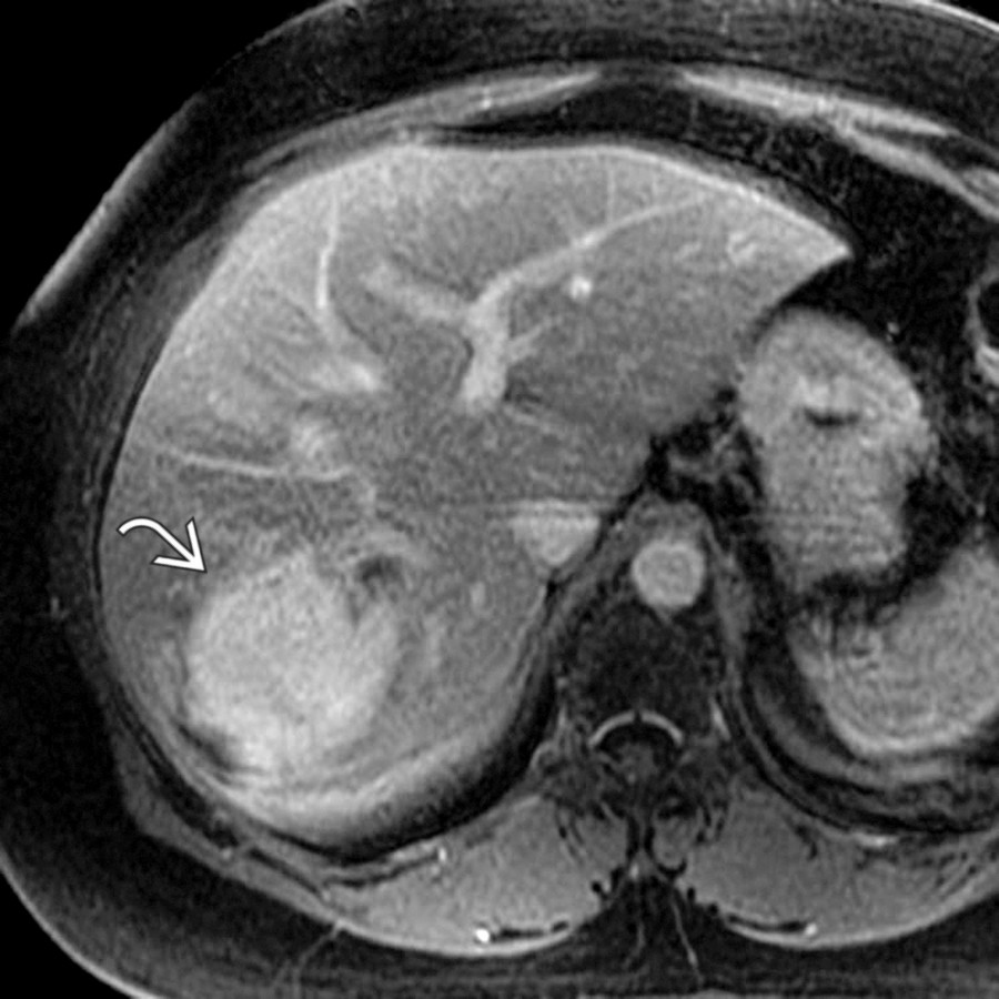 S03-FIG-04B|T1 C+ FS MR/axial:圖 2/2。對比增強 T1 MRI 可見病灶由周邊向心填充,且增強程度接近血池,符合典型 hemangioma pattern。