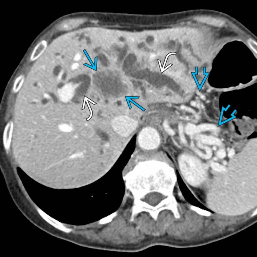 S03-FIG-06B|CECT, portal venous phase/axial:圖 2/2。門脈期 CECT:肝門層級低密度 cholangiocarcinoma 侵犯肝實質,造成雙葉顯著肝內膽管擴張;另見門脈阻塞相關胃脾靜脈曲張。